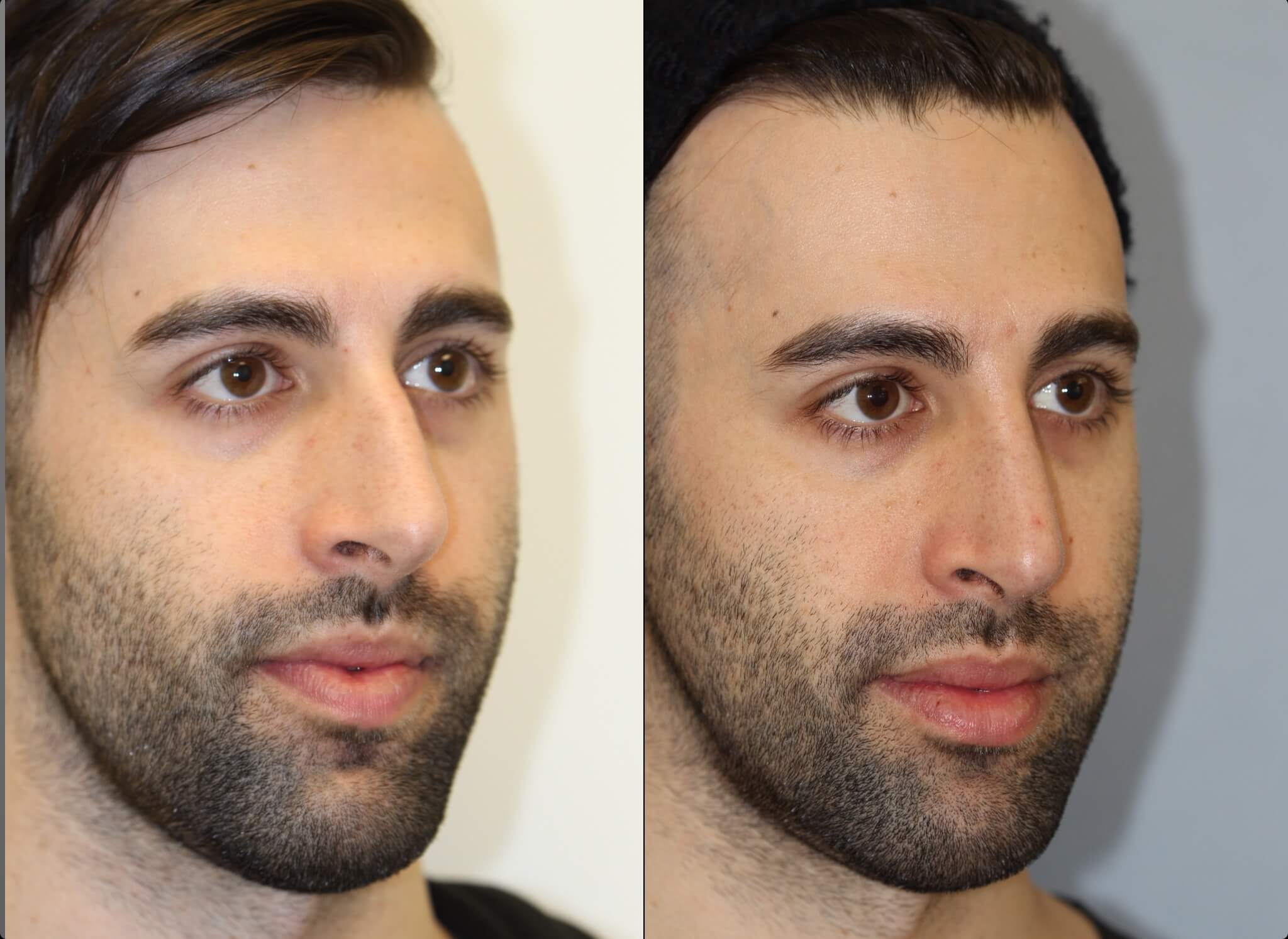 what is rhinoplasty
