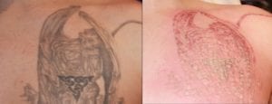 Normal appearance of a tattoo at the end of the first laser tattoo removal session