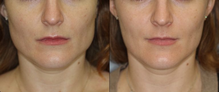 Botox For Masseter Muscle Hypertrophy New York City Dr Dara Liotta botox-for-masseter-muscle-hypertrophy-new-york-city-dr-dara-liotta