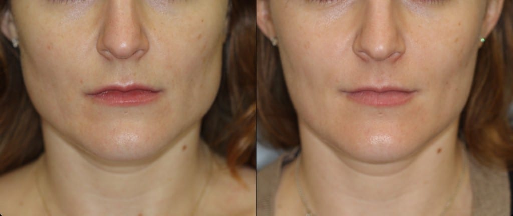 Botox For Masseter Muscle Hypertrophy New York City Dr Dara Liotta botox-for-masseter-muscle-hypertrophy-new-york-city-dr-dara-liotta