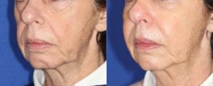 Typical results of a Liquid Facelift