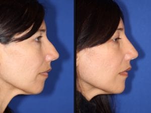 Typical Results of a Liquid Rhinoplasty