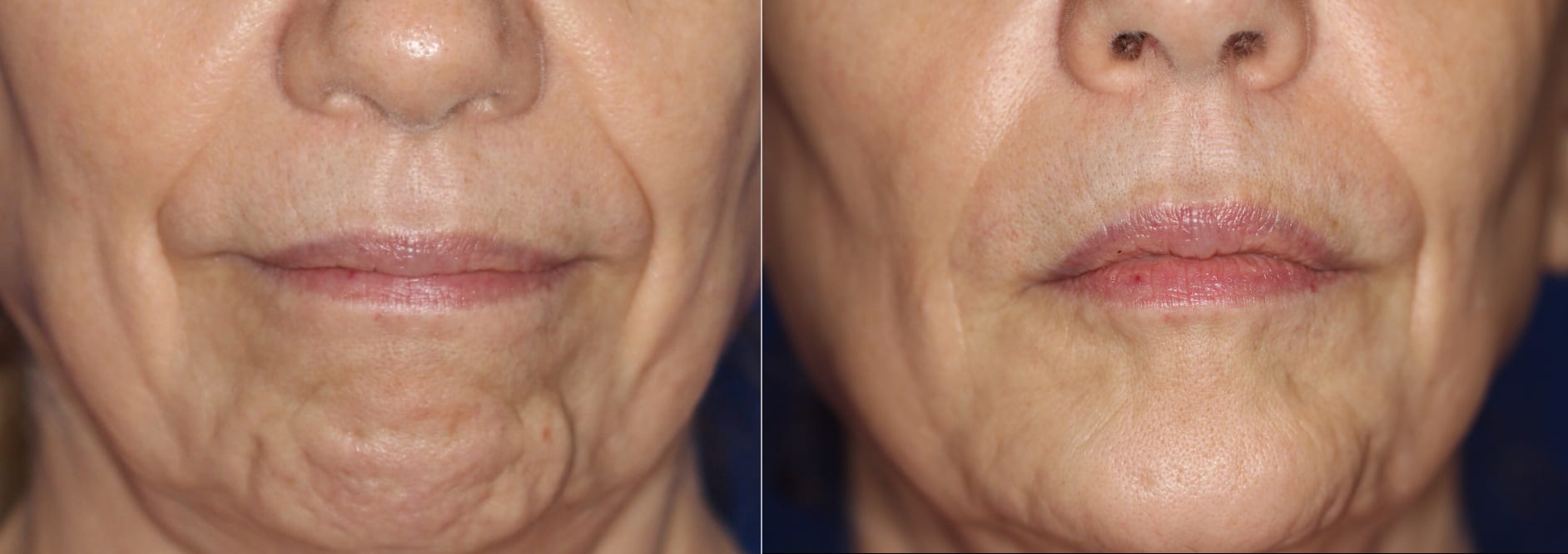 Botox can be used in the chin to smooth out dimpling in the skin