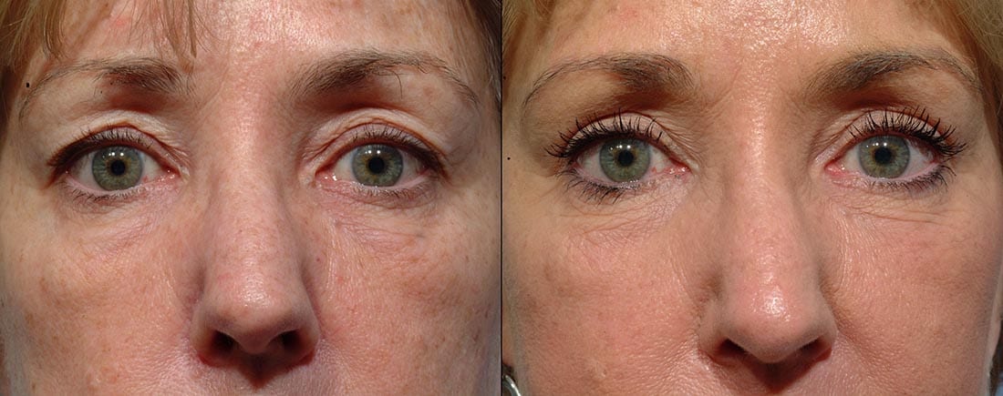 Eyelid Surgery - Before and After