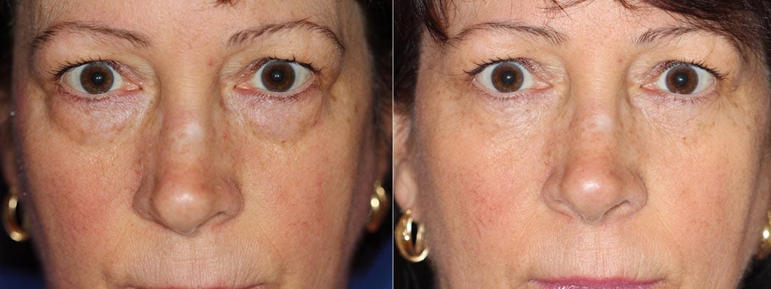 Eyelid Surgery Blepharoplasty - New York City - Dr. Dara Liotta