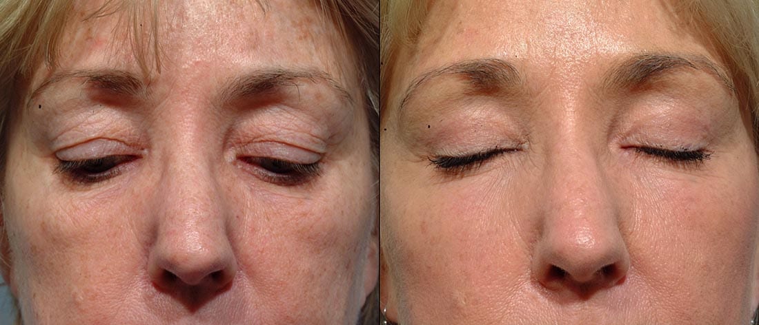 Dr. Dara Liotta - Eyelid Surgery - Before and After - Eyes closed