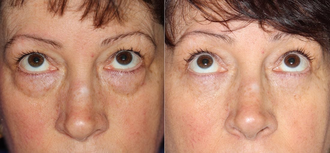 Dr. Dara Liotta - Eyelid Surgery - Before and After - Patient looking up