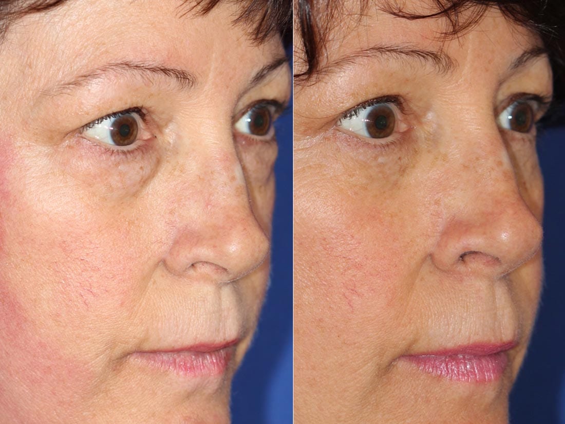 Dr. Dara Liotta - Eyelid Surgery - Before and After Profile