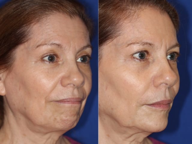 JUVEDERM® before and after.*Individual results may vary.