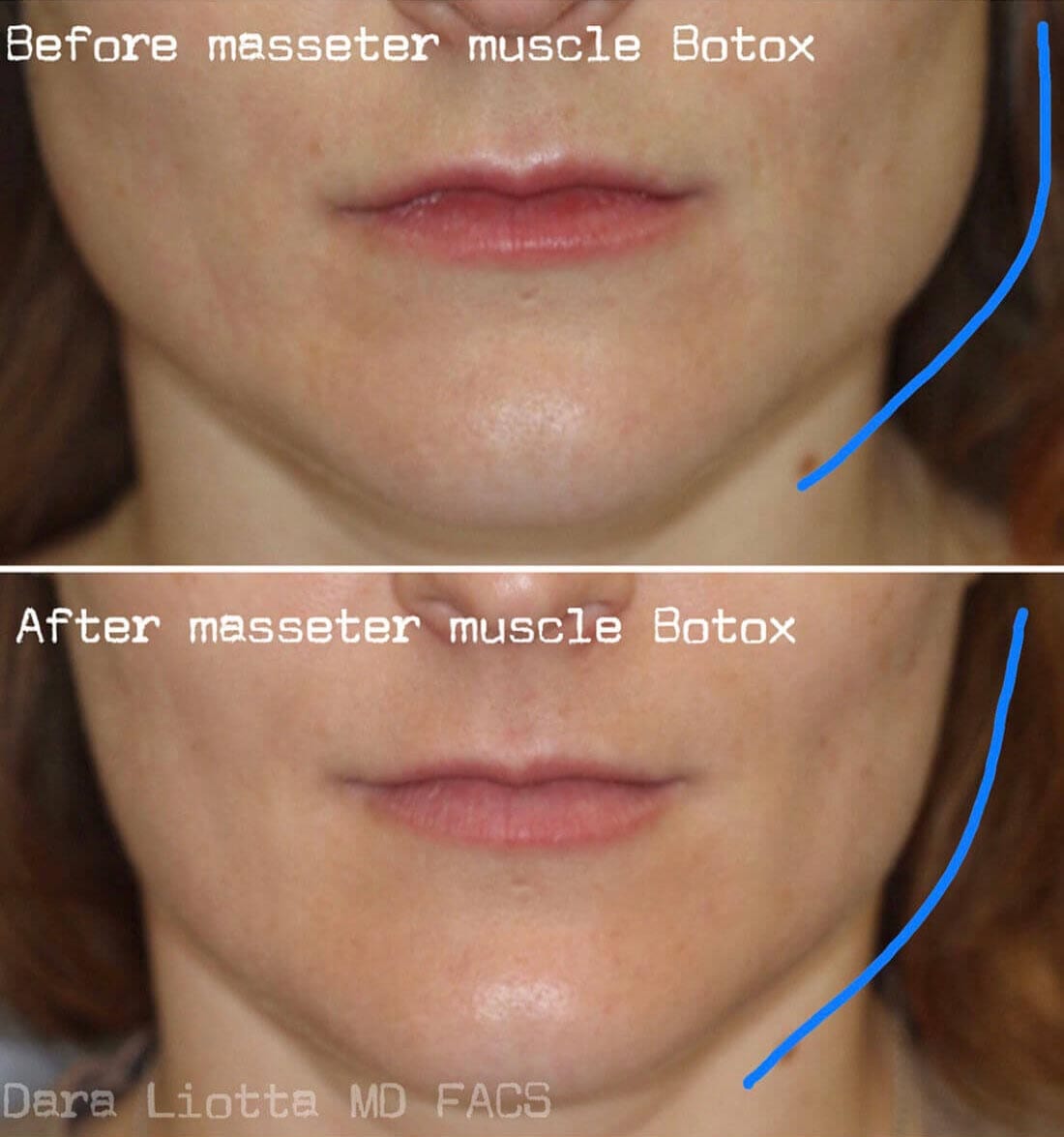 Before and after BOTOX® Cosmetic Masseter muscle