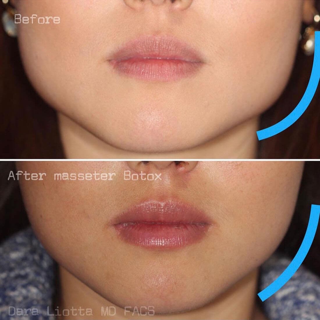 Before and after BOTOX® Cosmetic Masseter muscle