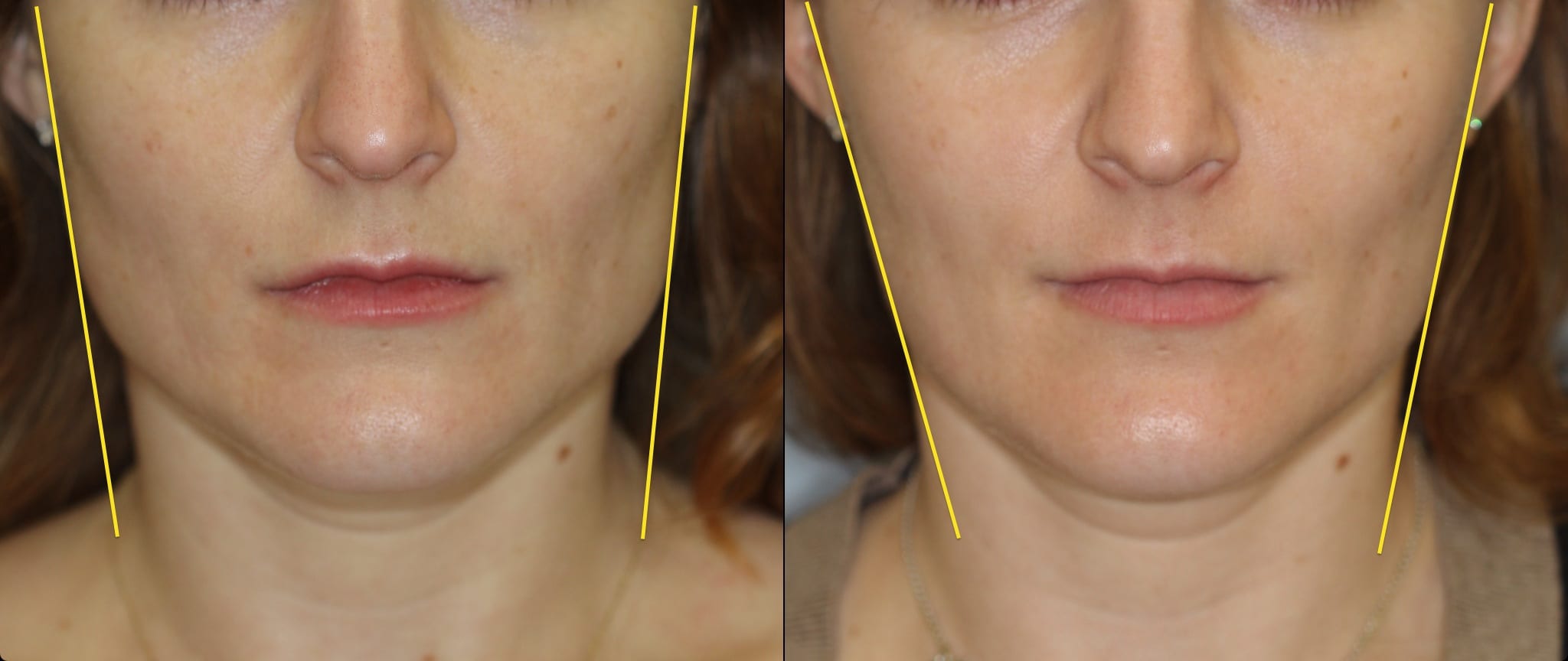 Woman's Masseter Muscle Marked Up for BOTOX® Cosmetic