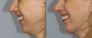 Before and after chin implant surgery, patient smiling
