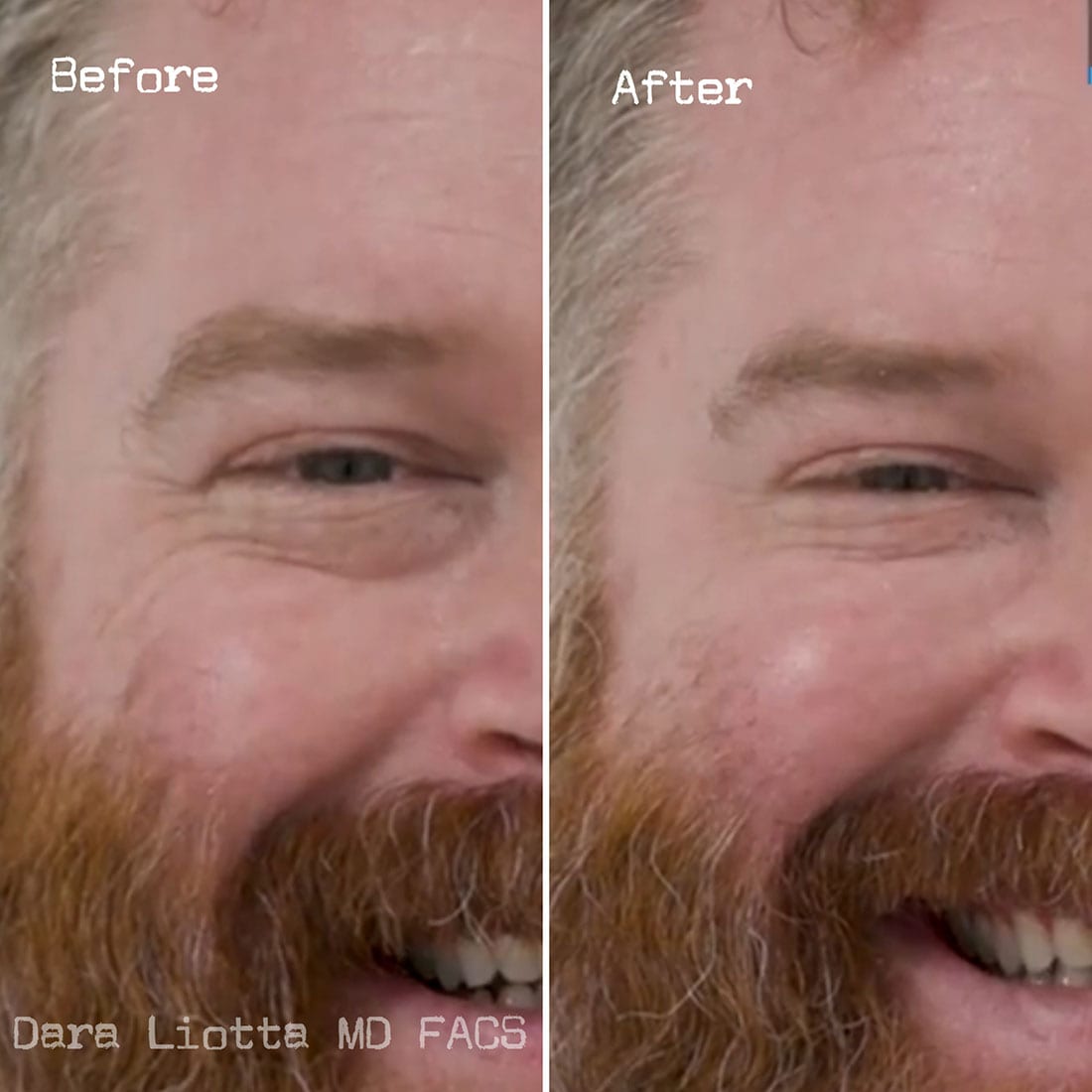 BOTOX® Cosmetic before and after 1