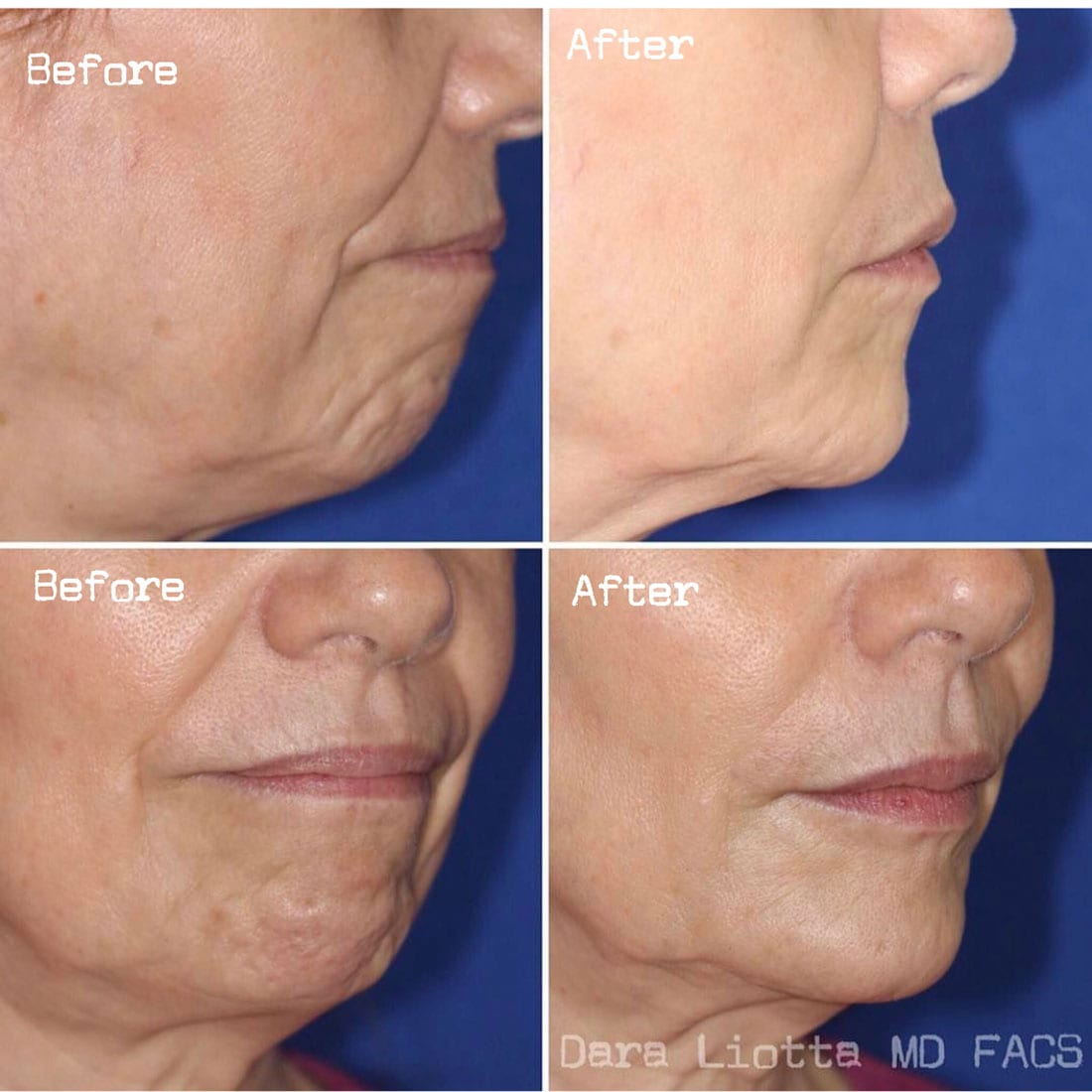 BOTOX® Cosmetic before and after patient 2