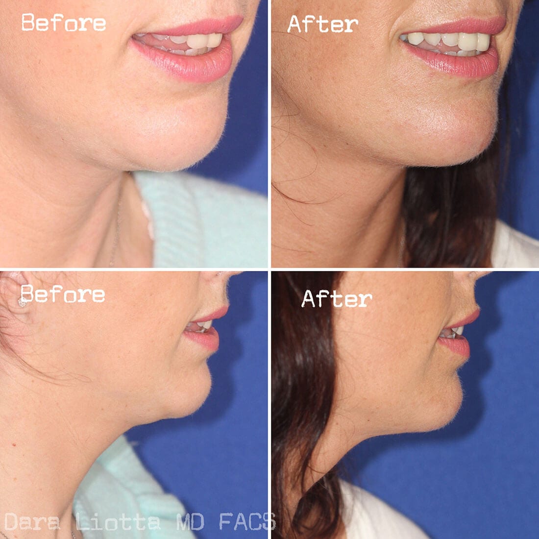 Neck Rejuvenation And Submental Liposuction New York City Dr Dara