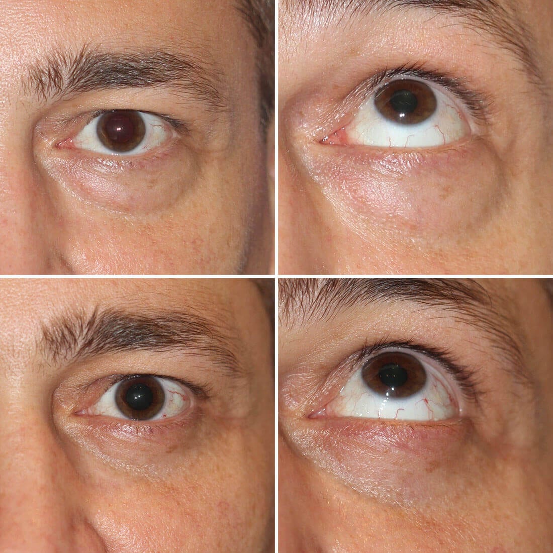 Eyelid Surgery Blepharoplasty New York City Dr Dara Liotta