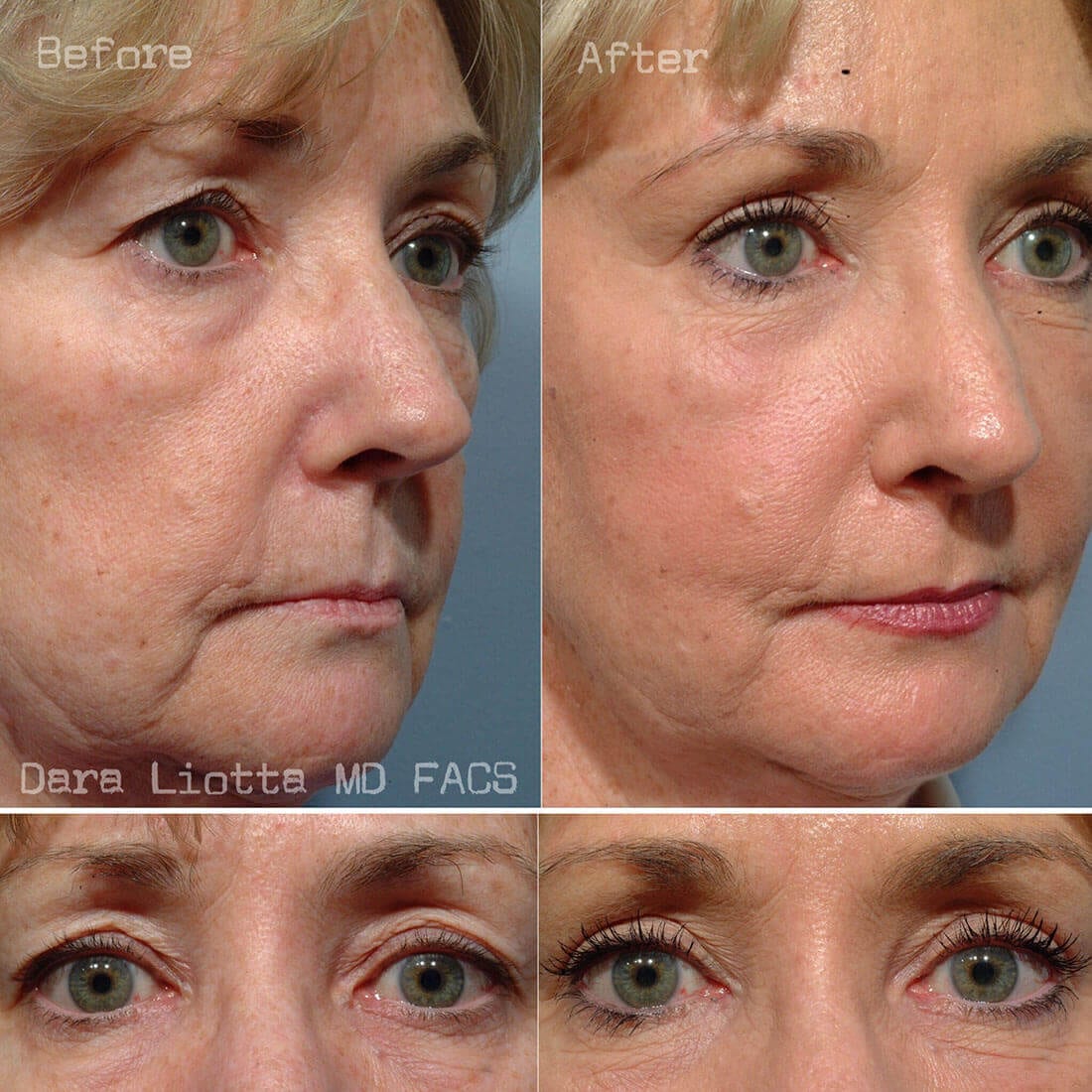 Before and After Eyelid Surgery 04