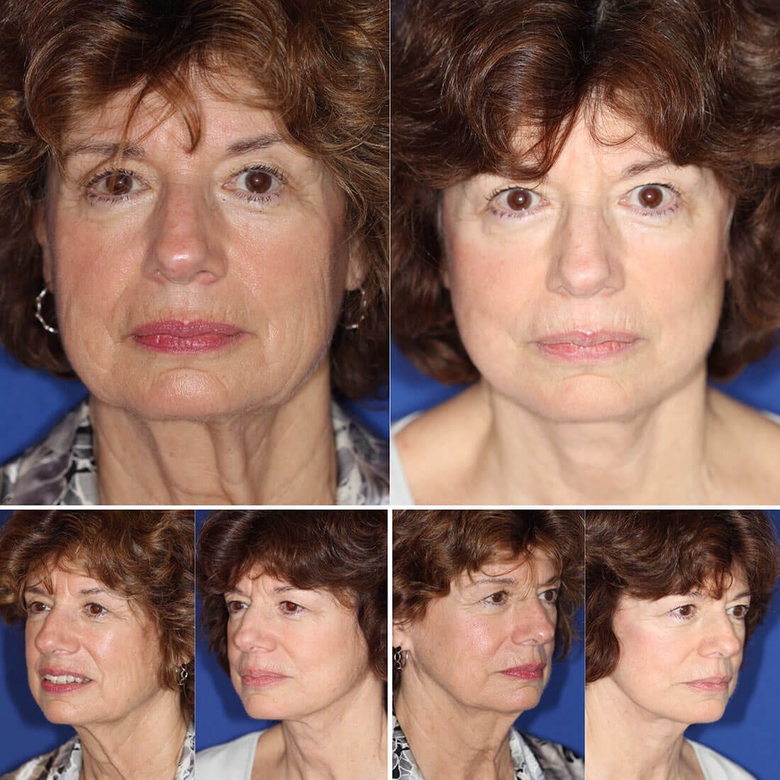 Facelift and Neck Lift Before and After Photo 01