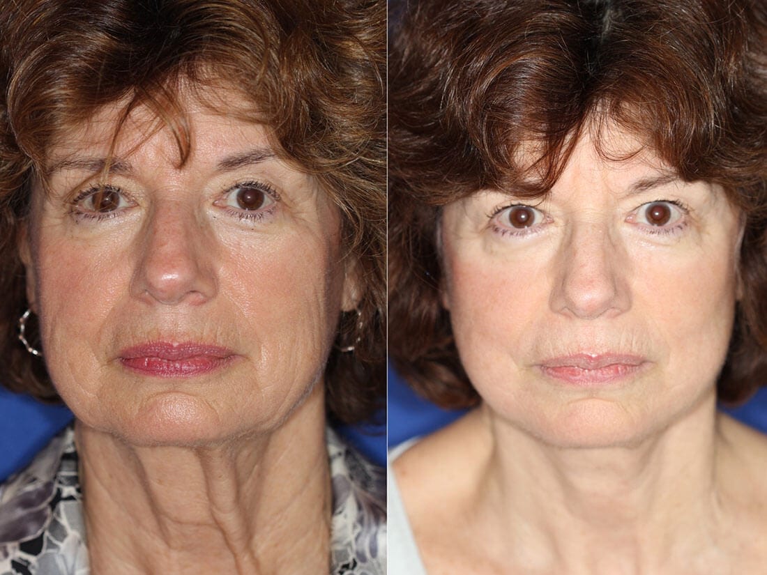 Facelift and Neck Lift Before and After Photo 01a