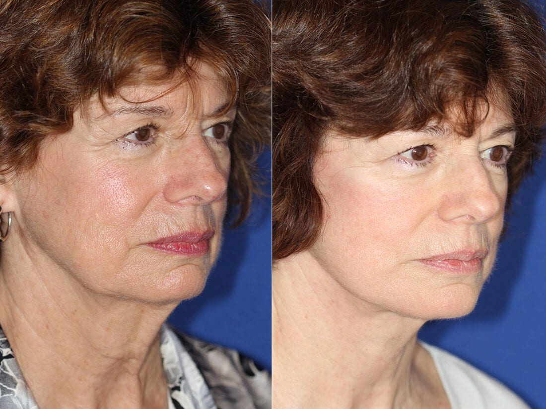 Facelift and Neck Lift Before and After Photo 01b