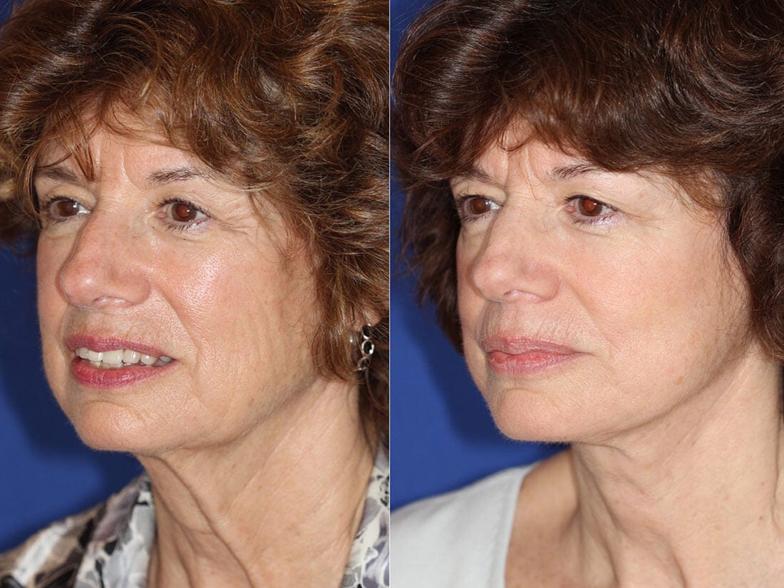 Facelift and Neck Lift Before and After Photo 01c