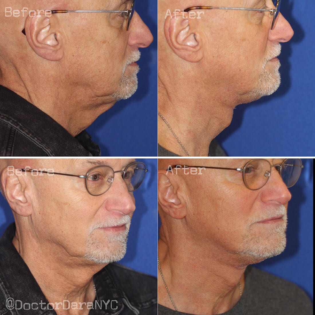 Facelift and Neck Lift Before and After Photo 02