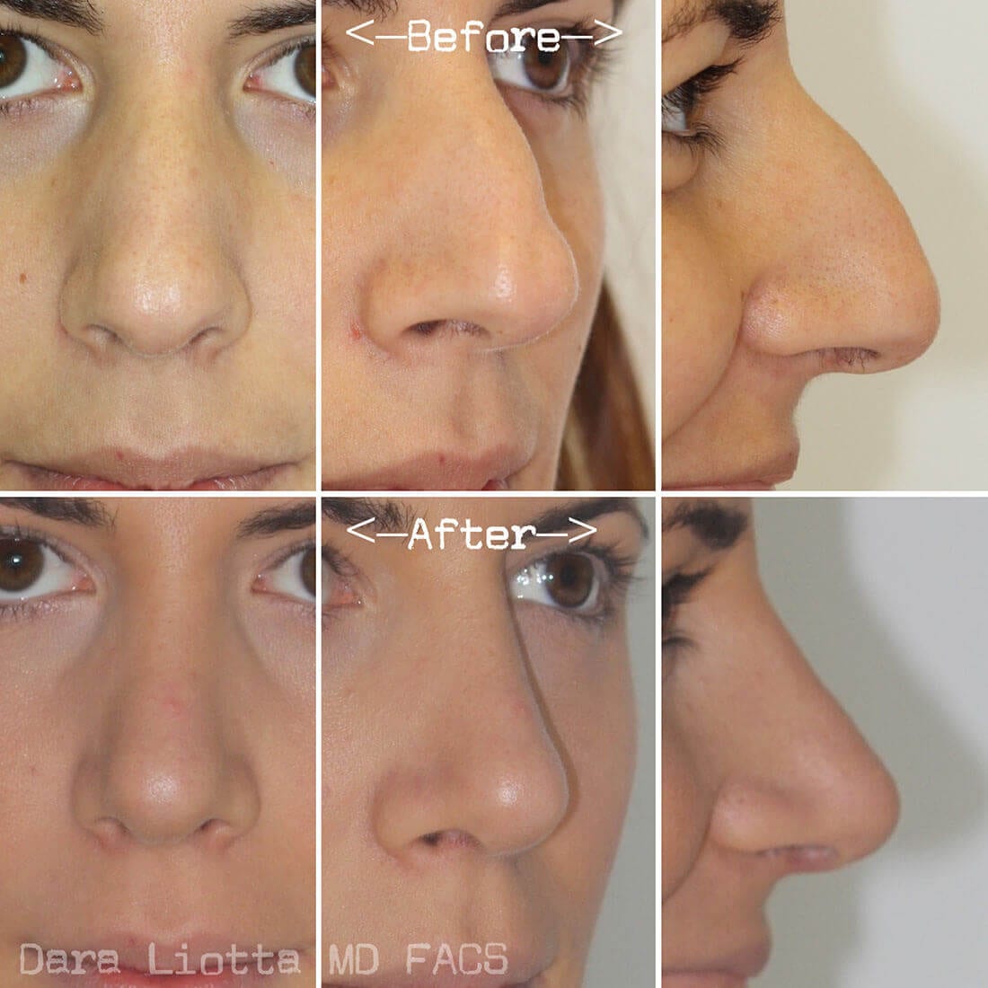 Rhinoplasty Dr Dara Liotta