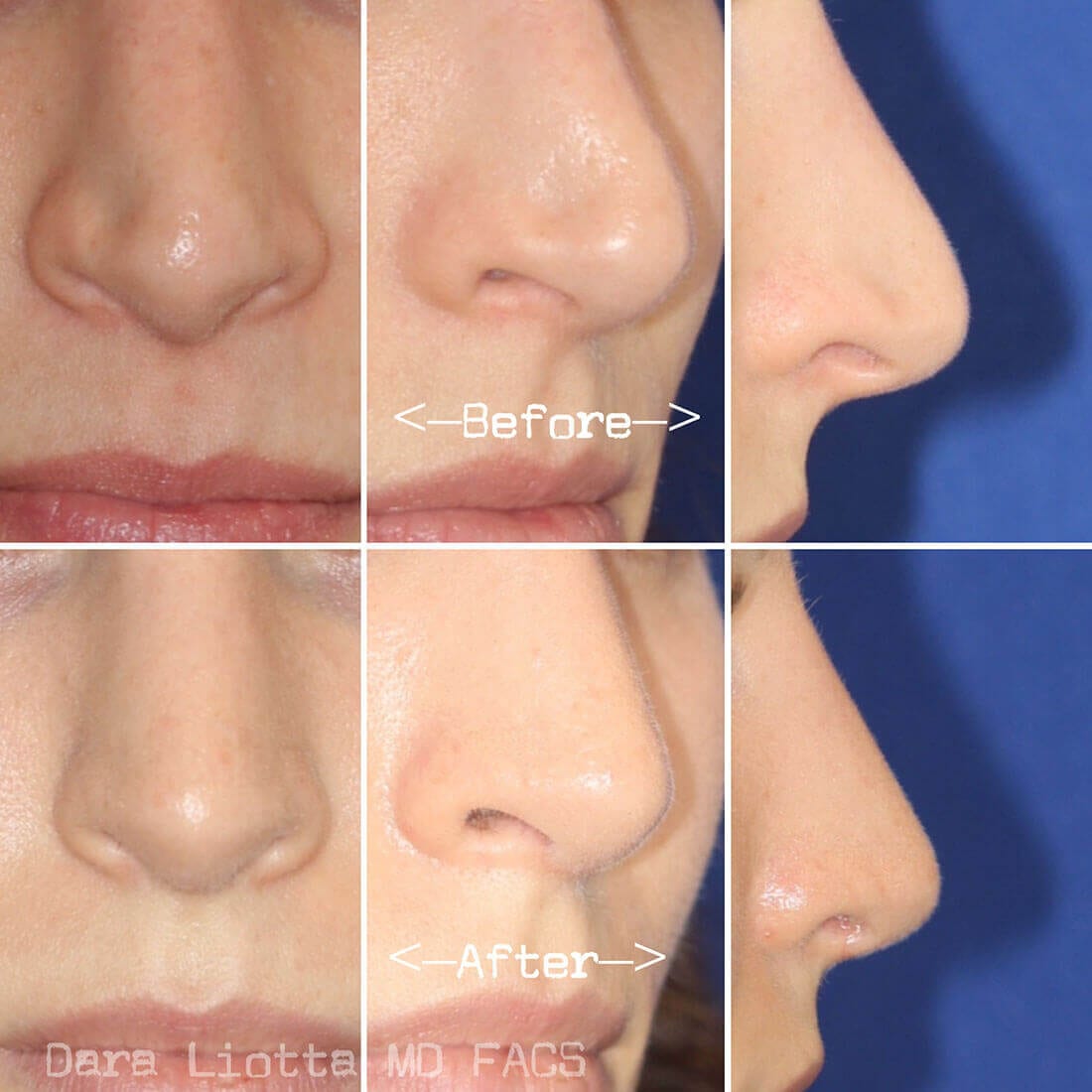 Rhinoplasty Archives Page Of Dr Dara Liotta