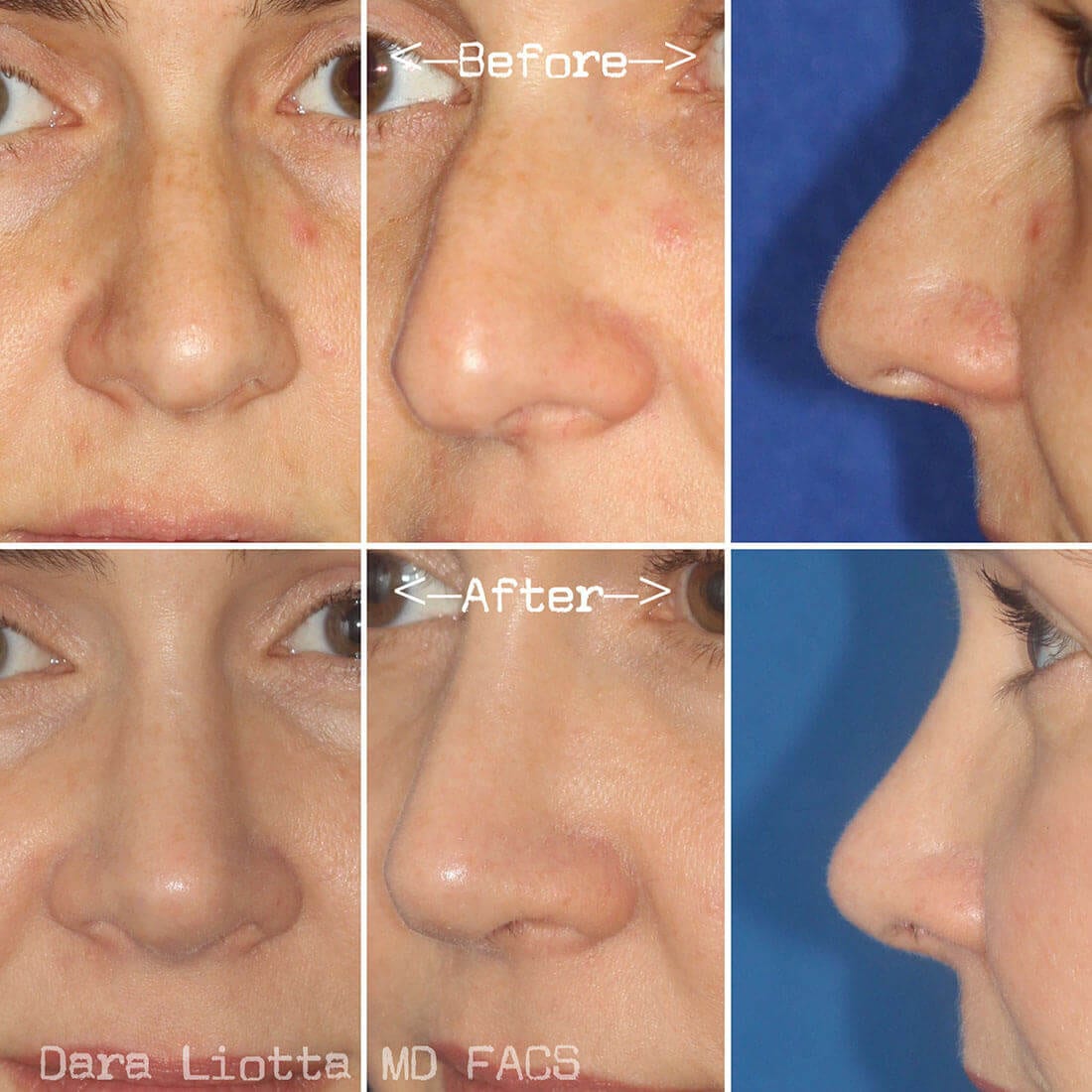 Rhinoplasty Archives Dr Dara Liotta