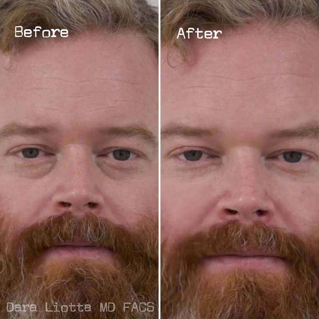 Under Eye Filler Before and After Results by Dr. Liotta 01