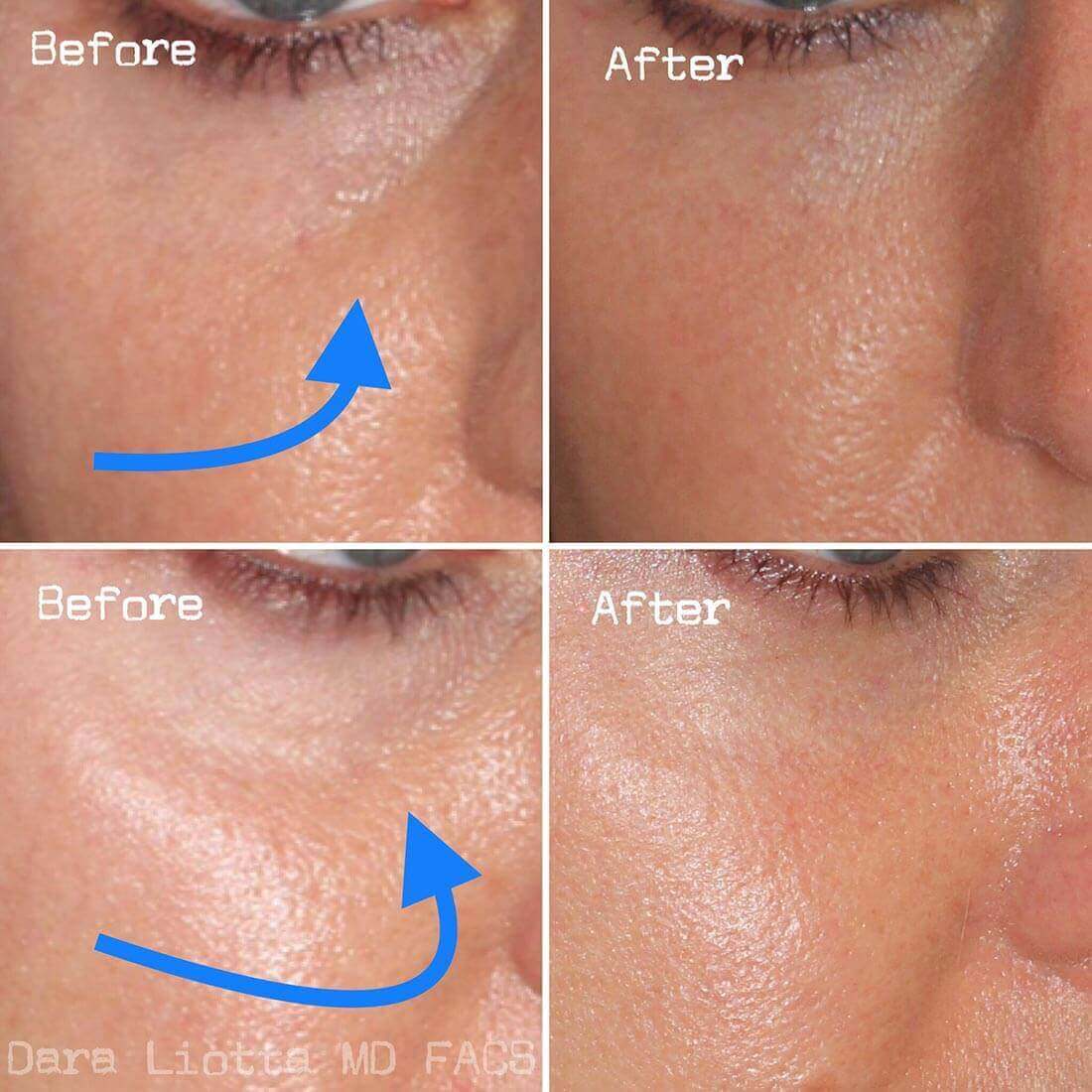 Under Eye Filler Before and After Results by Dr. Liotta 02