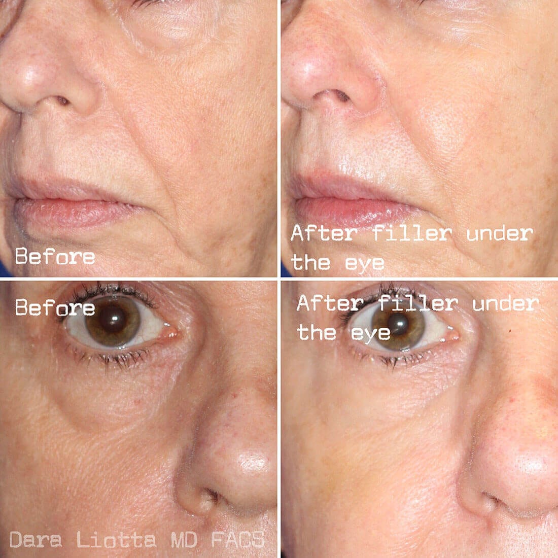 Under Eye Filler Before and After Results by Dr. Liotta 03